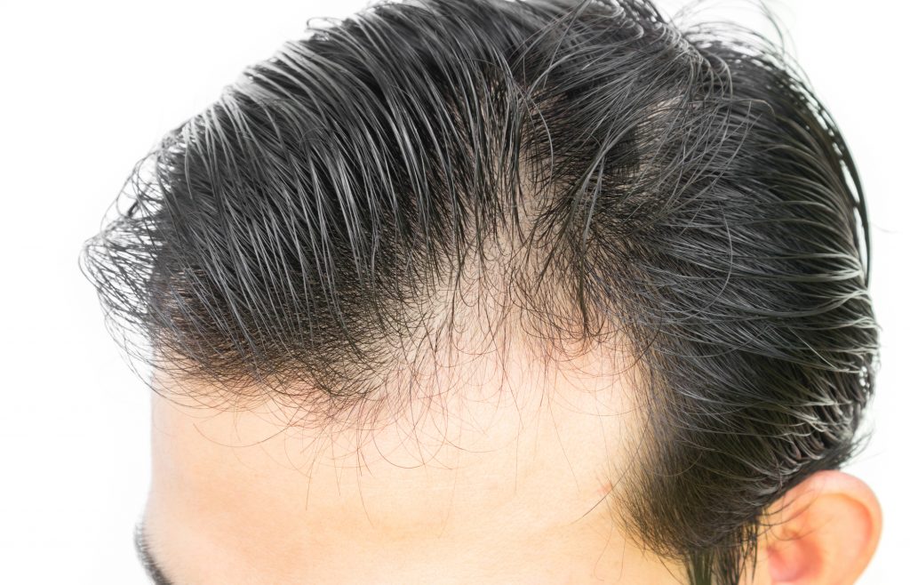 ワックスが頭皮に与える悪影響 原因と対策方法 薄毛対策室