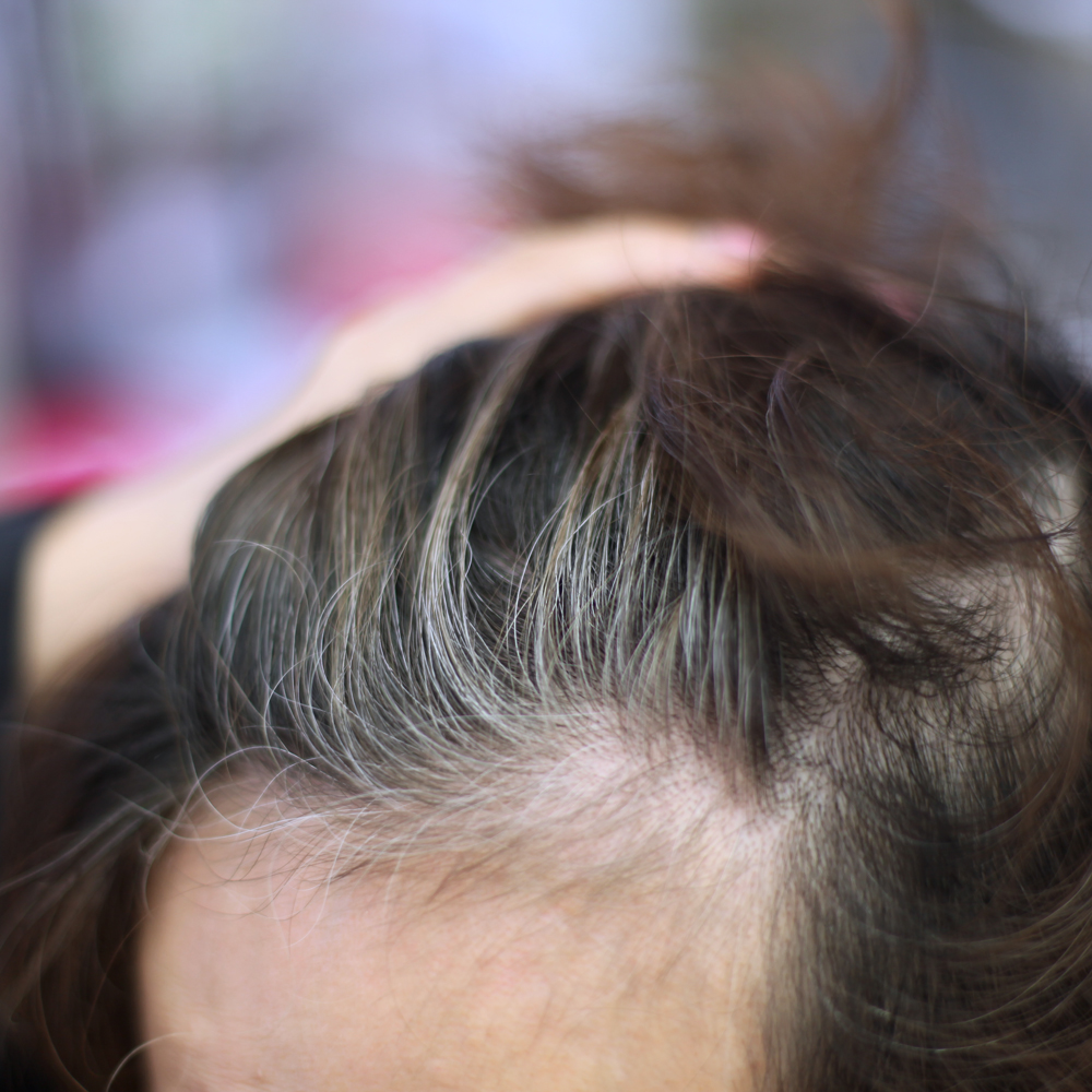 前髪の抜け毛 薄毛が気になる 女性の薄毛の原因と対策 薄毛対策室