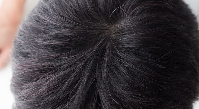 毛穴が詰まる原因とは 頭皮の角栓が髪の毛に与える影響や取り方 薄毛対策室