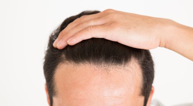 おでこが広いのが悩み 男女別 おすすめの髪型とヘアケア方法 薄毛対策室