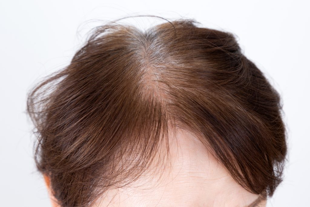前髪の抜け毛はagaの兆候 考えられる原因と予防方法とは 薄毛対策室